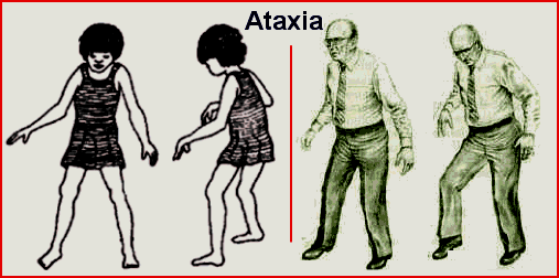 Resultado de imagen de tipos de ataxia